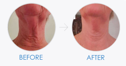 asea-renu-28-before-after-2